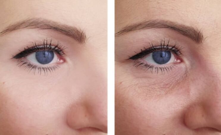 antes y después del rejuvenecimiento con plasma alrededor de los ojos