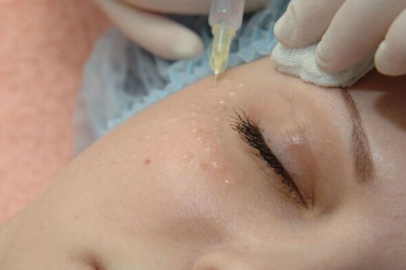 Mesoterapia un método de inyección para el rejuvenecimiento de la piel del rostro